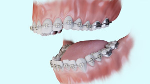 Traitement multi-attaches