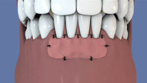 Greffe gingivale libre